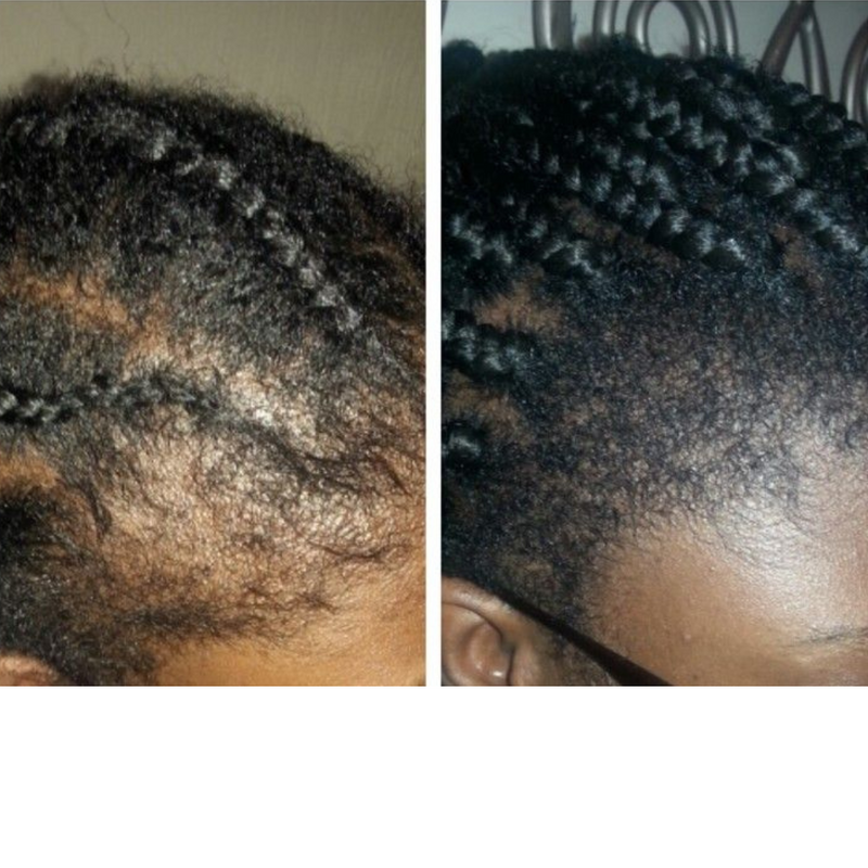 Tight braids had me looking crazy for years - Kendra S.